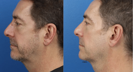 Before and after of male jaw contouring in new york