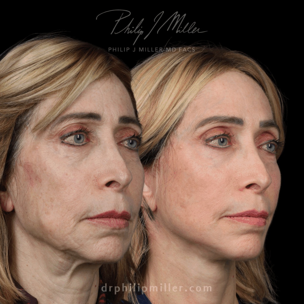before and after facelift in nyc