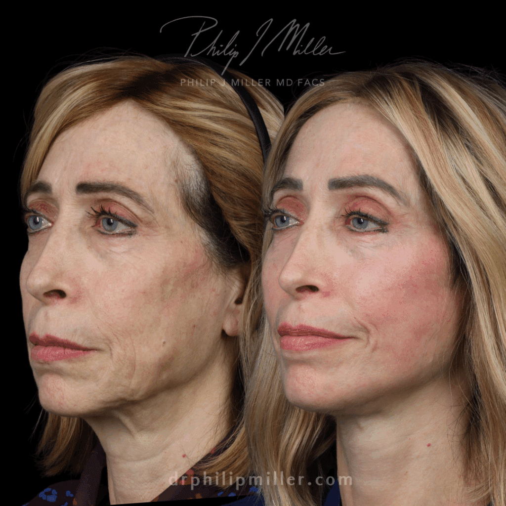 Combined facelift and neck lift to lift and tighten the skin around the face and neck, unveiling a rejuvenated and naturally youthful appearance by Dr. Miller.