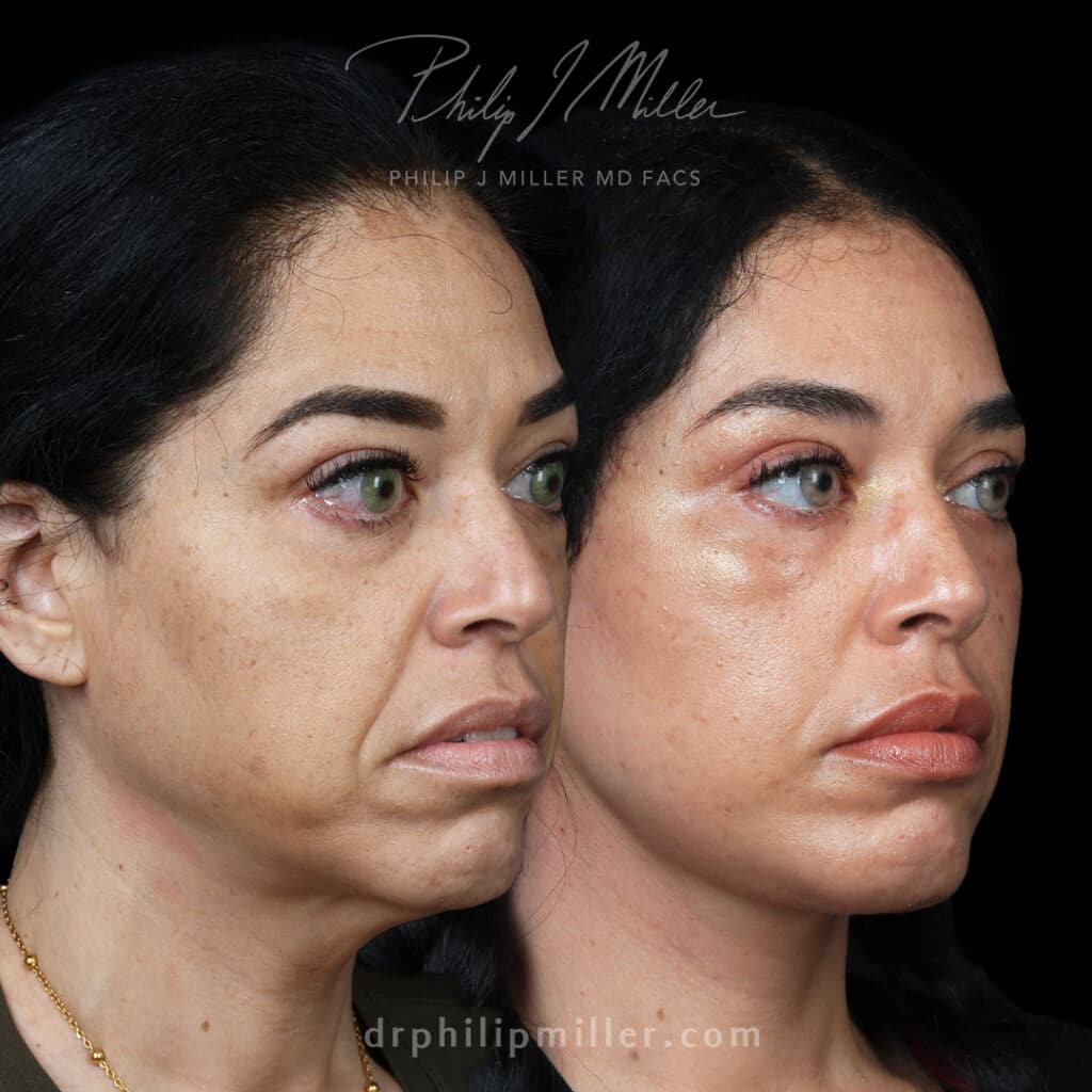 Fat Graft Before and After Photos of a female patient by Dr Philip Miller at NYC