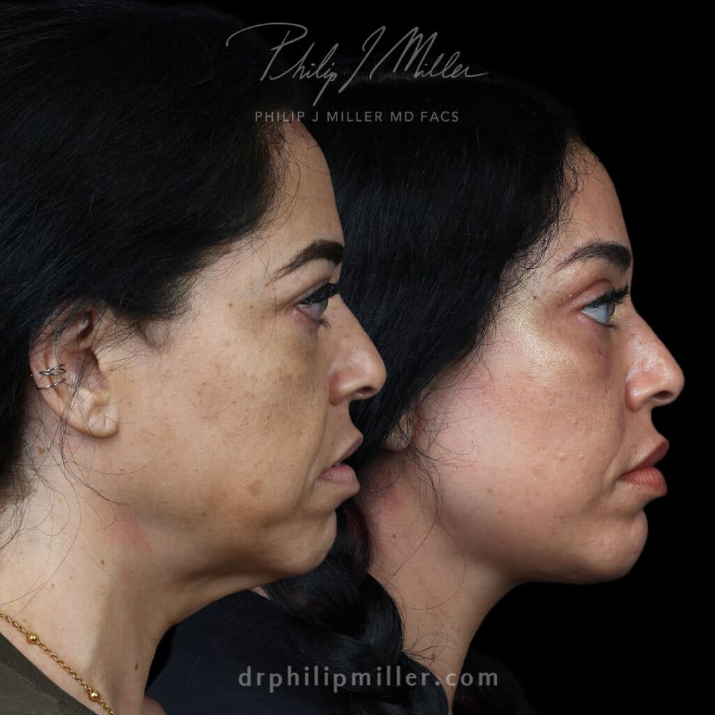 deep face neck lift and fat grafting before and after