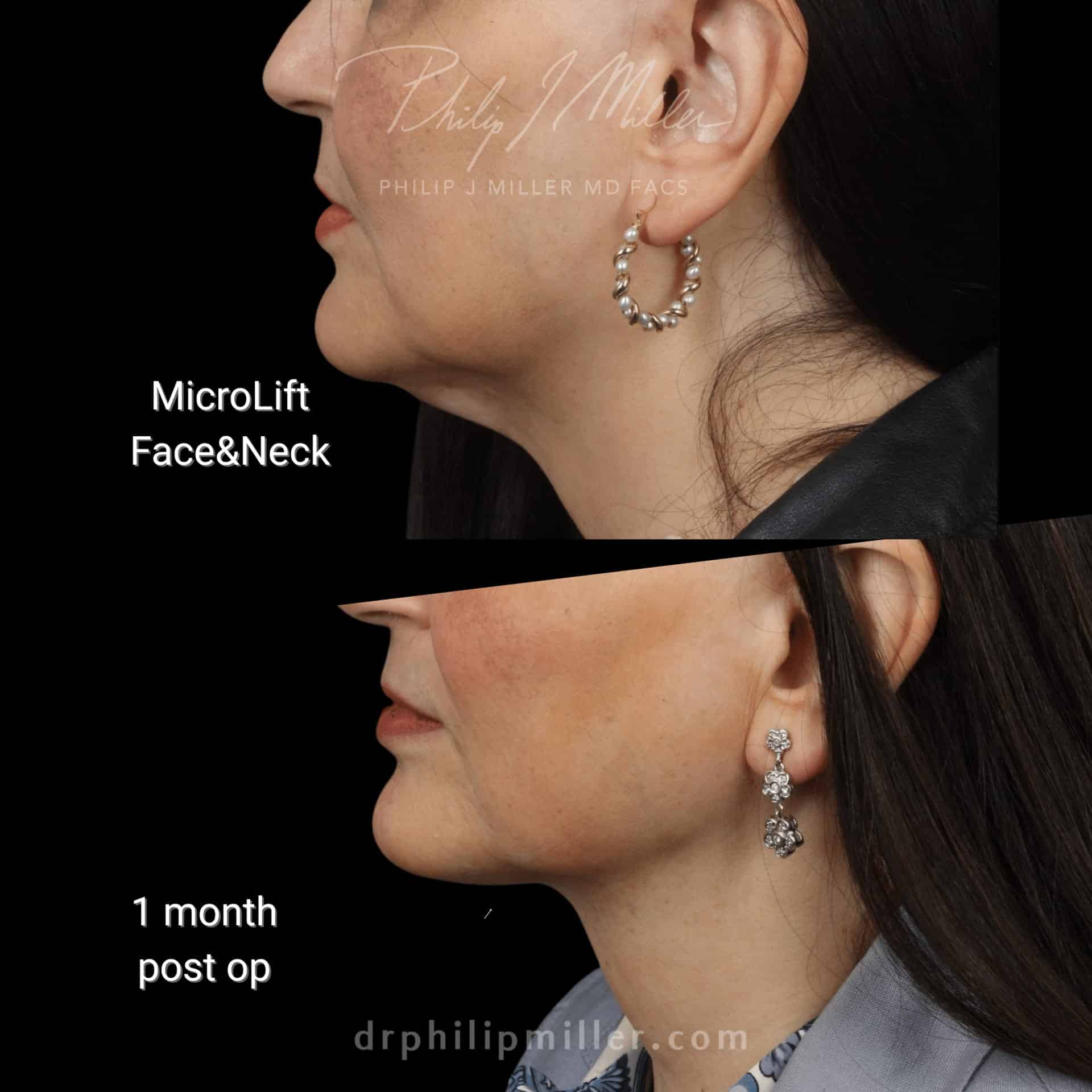 Microlift before and after photos of a female patient