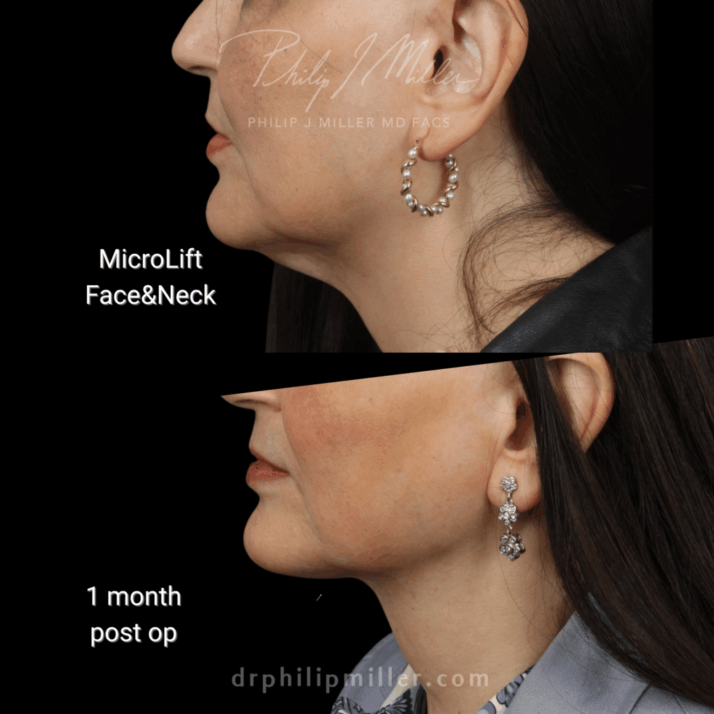 Microlift before and after photos of a female patient