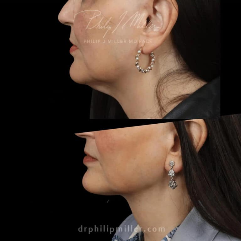 Microlift before and after photos of a female patient