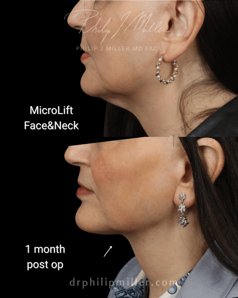 Micro Lift Before and After photos by Dr Philip Miller at NYC