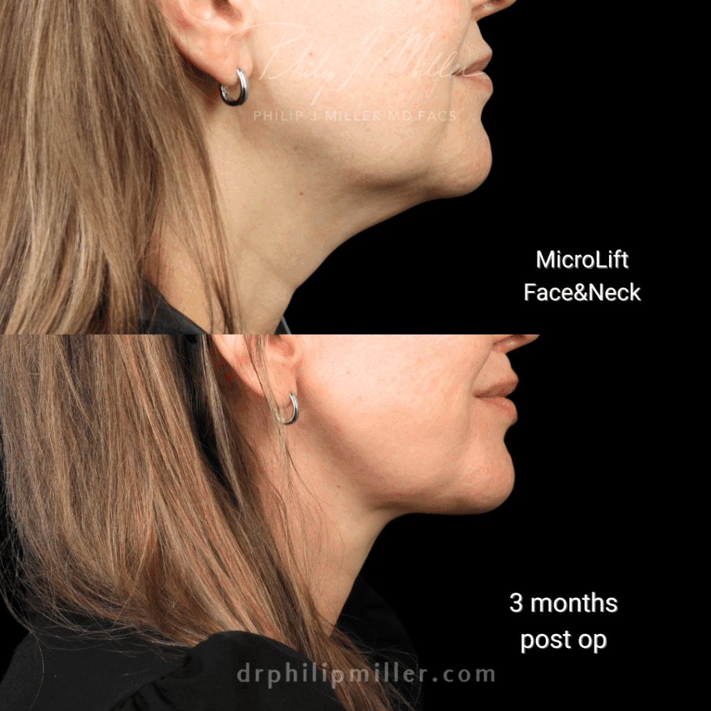 Before and after of female microlift procedure