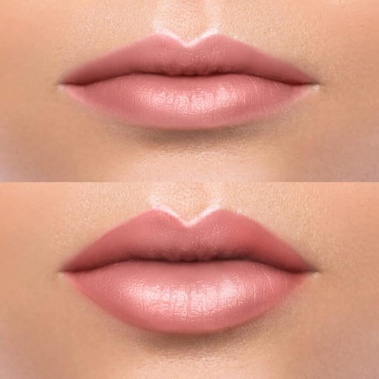 lip lift before and after (not an actual patient)
