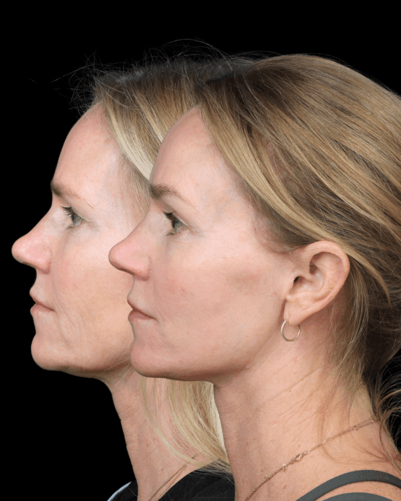 Before and after photos of a female patient who received Deep Plane Face & Neck Lift With Brow Lift for Natural Rejuvenation