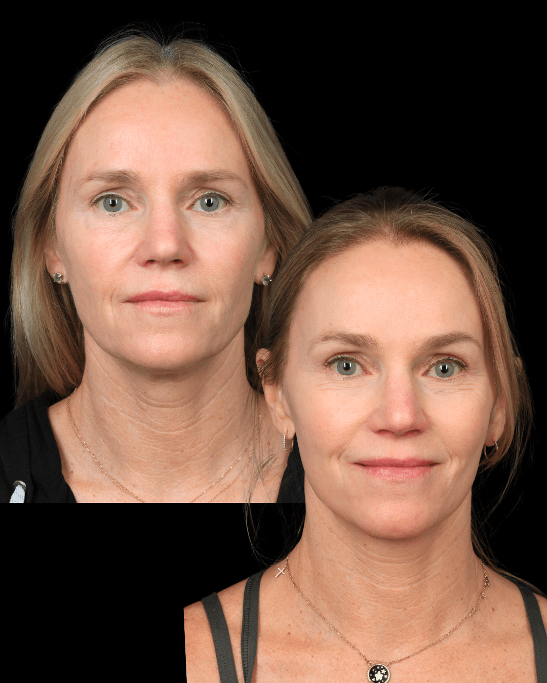 Before and after photos of a female patient who received Deep Plane Face & Neck Lift With Brow Lift for Natural Rejuvenation