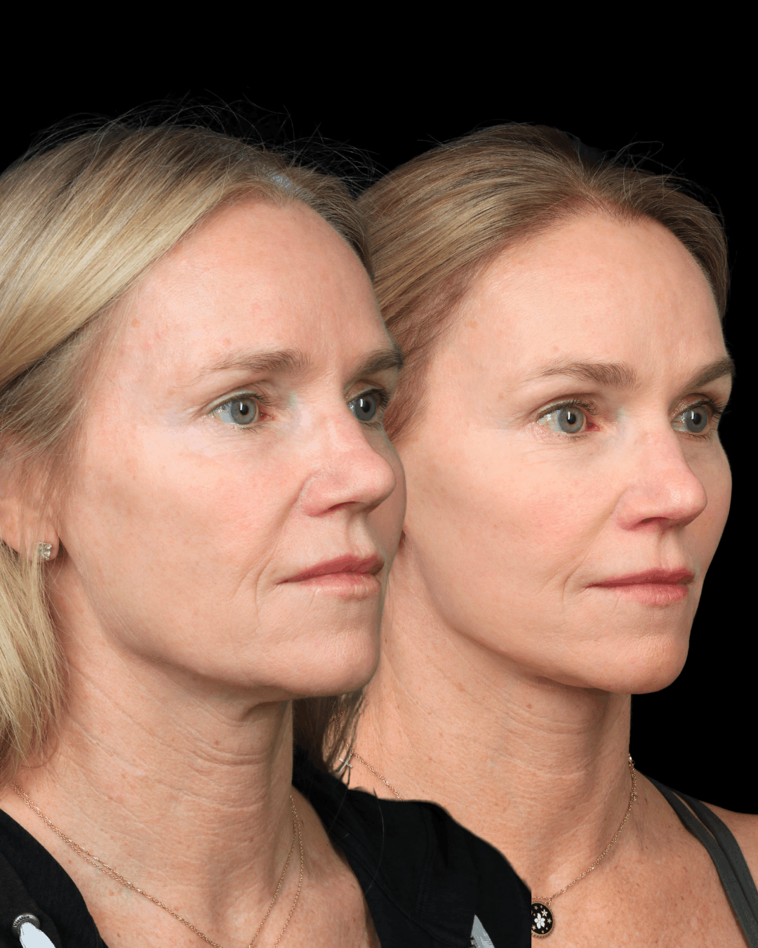 Before and after photos of a female patient who received Deep Plane Face & Neck Lift With Brow Lift for Natural Rejuvenation