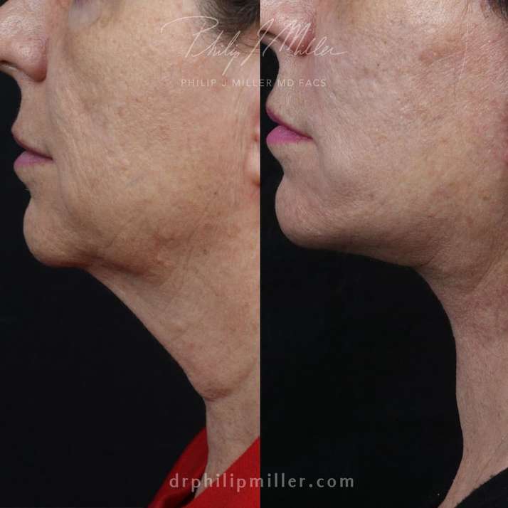 Facelift to treat sagging skin in lower face by dr philip miller nyc