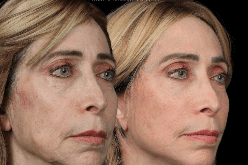 Facelift before and after photos