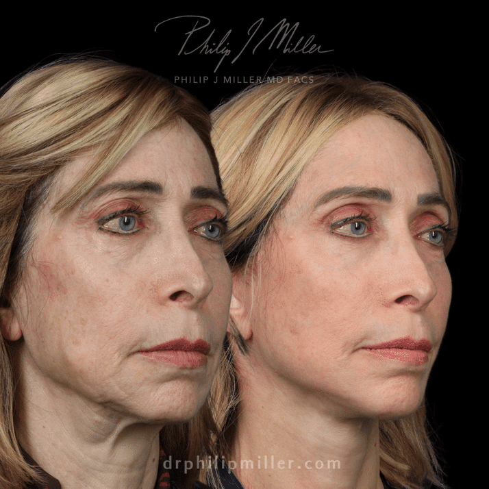 Facelift before and after photos