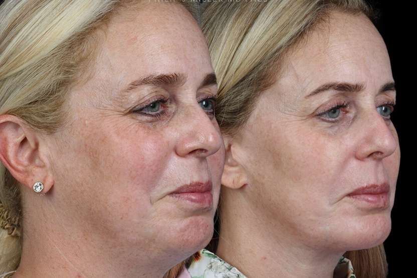Miller NYC  facelift Before and after photos