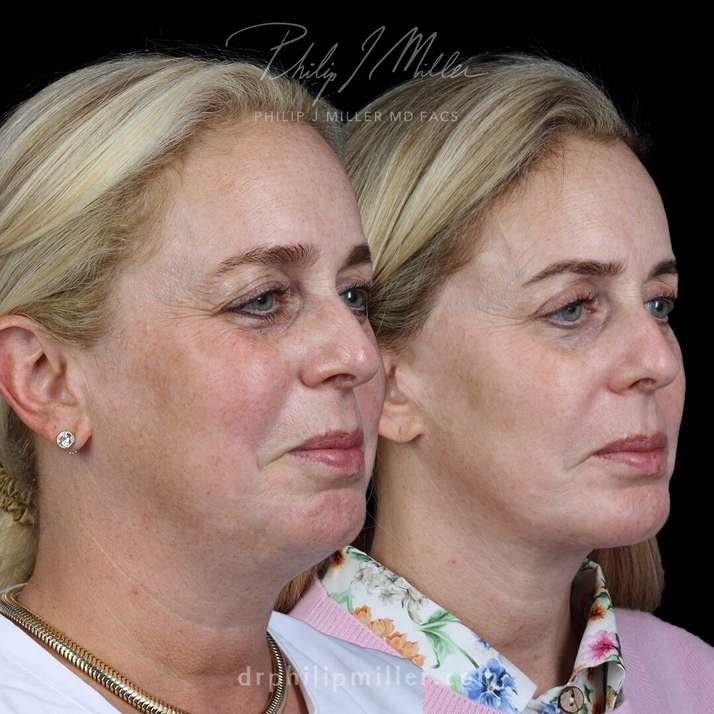 Dr Philip Miller new york city before and after photos of a facelift