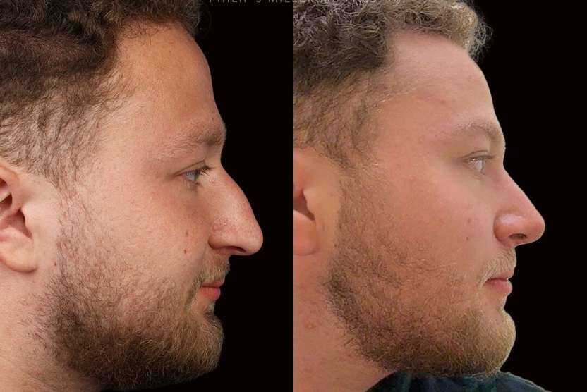 dr philip miller nyc rhinoplasty male before and after photos after 3 months