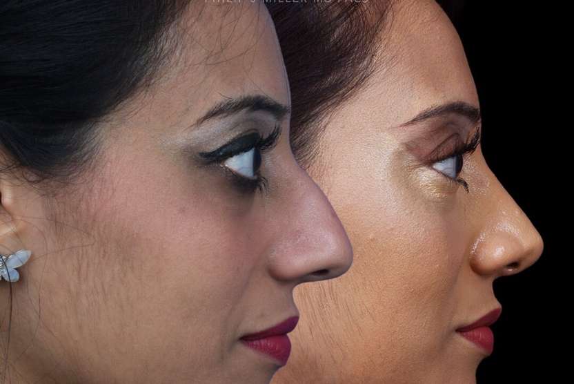 dr philip miller nyc rhinoplasty 8 years before and after photos