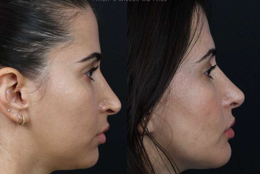 nyc rhinoplasty chin augmentation before and after photos female by dr philip miller