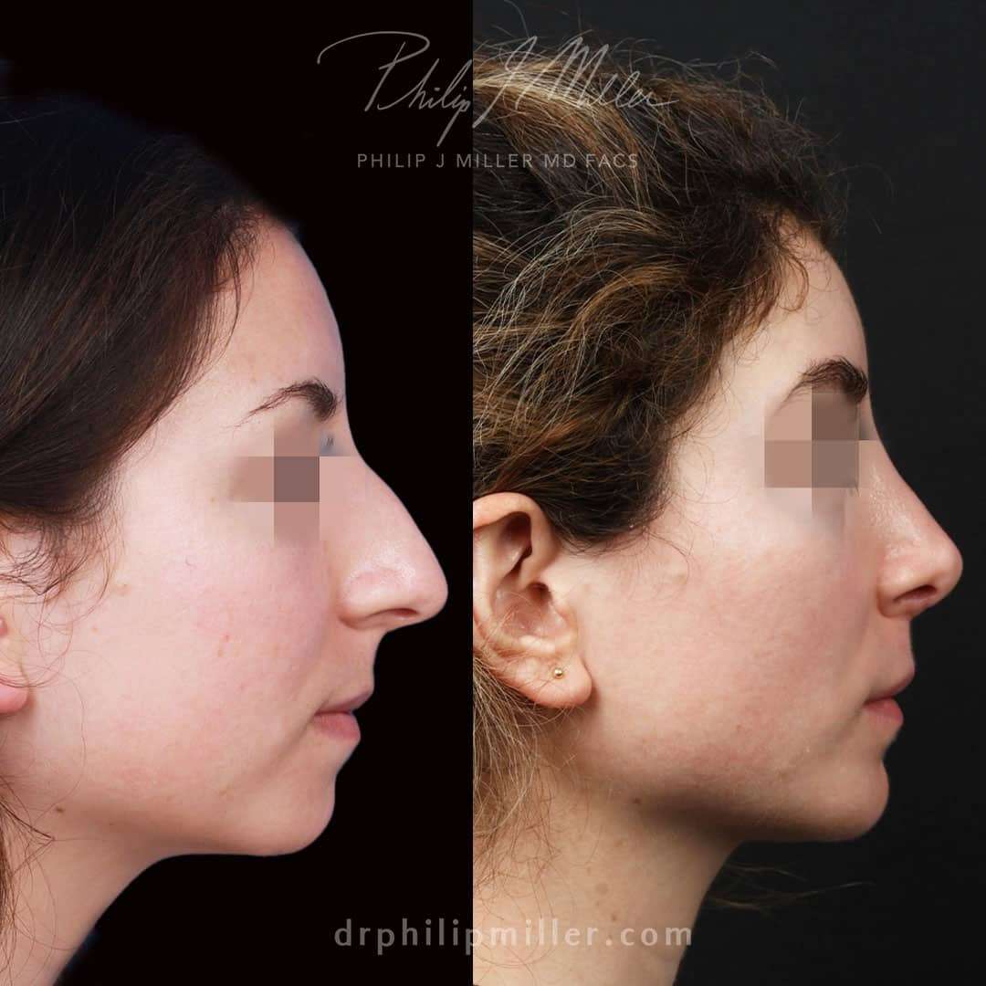 Revision Rhinoplasty before and after photos
