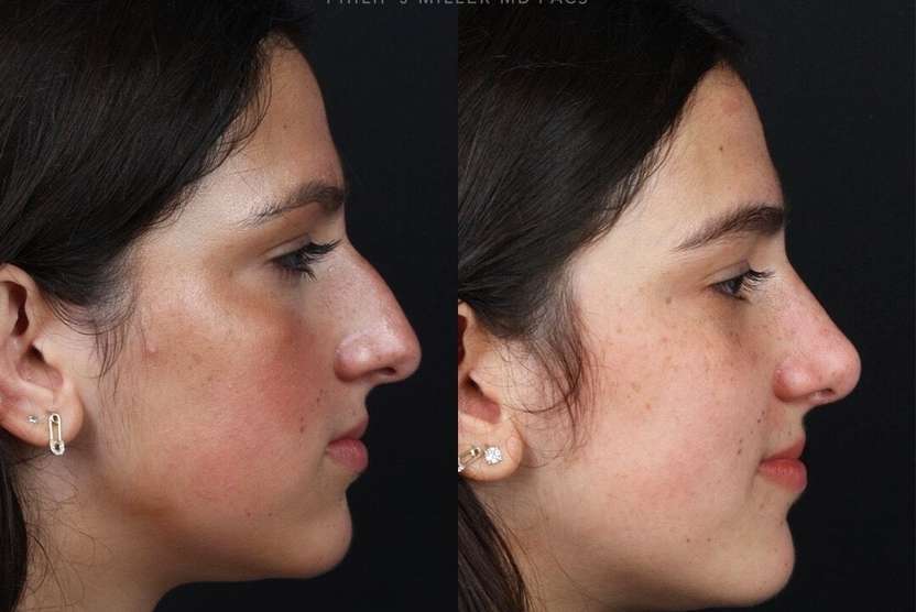 Facial plastic surgery rhinoplasty philip miller nyc before and after photos