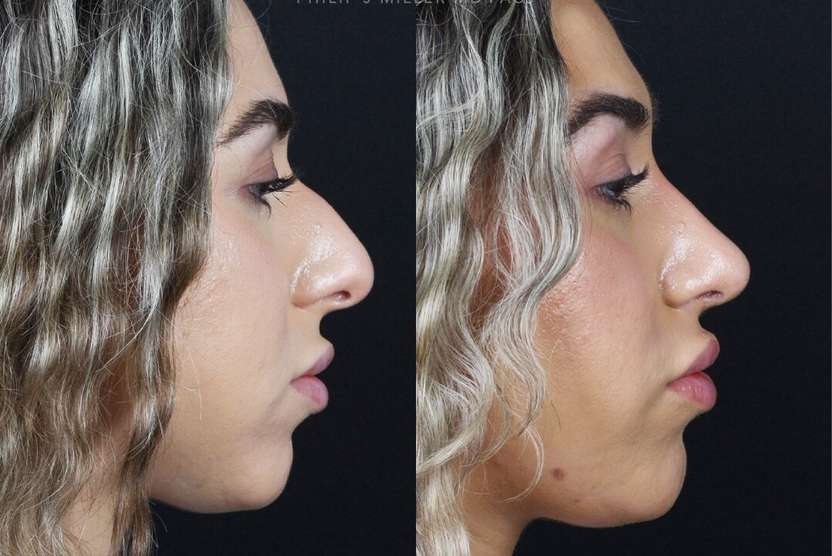 rhinoplasty by dr philip miller nyc before and after photos of a female patient