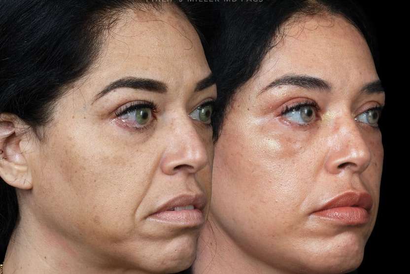 Deep faceneck fat graft before and after photos