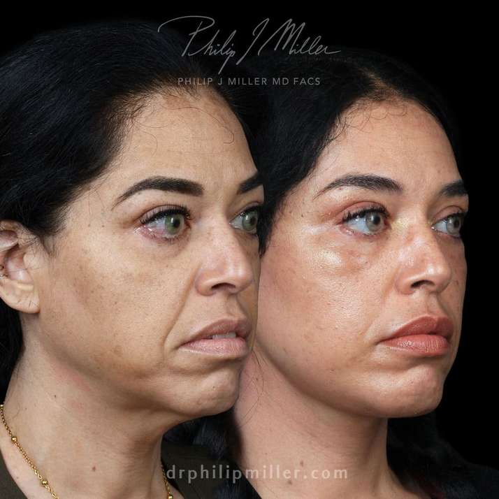 Deep Face/Neck Fat Grafting before and after photos