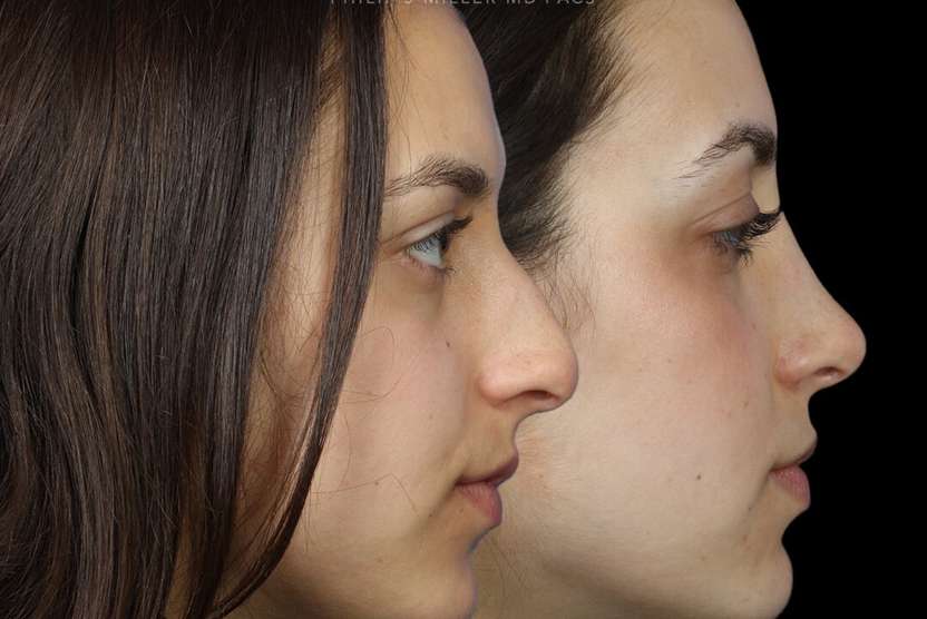 Vectra rhinoplasty before and after photos