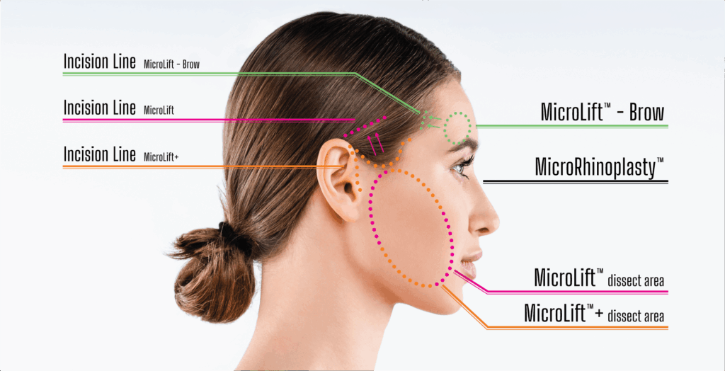 Graphic outlining where each microsurgery procedure's incision line and dissect are are on the face