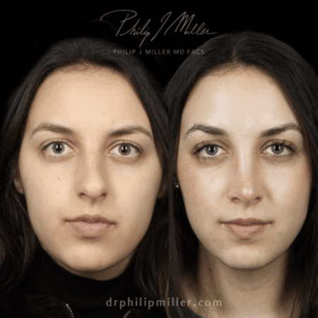 Rhinoplasty to straighten bridge and refine the nasal tip of a female patient by Dr. Miller. Surgery removes dorsal hump from bridge and refines the nasal tip to improve the patient's facial profile.